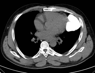 Fig 2: CT scan Confirming the Calcific Cardiac Tumor