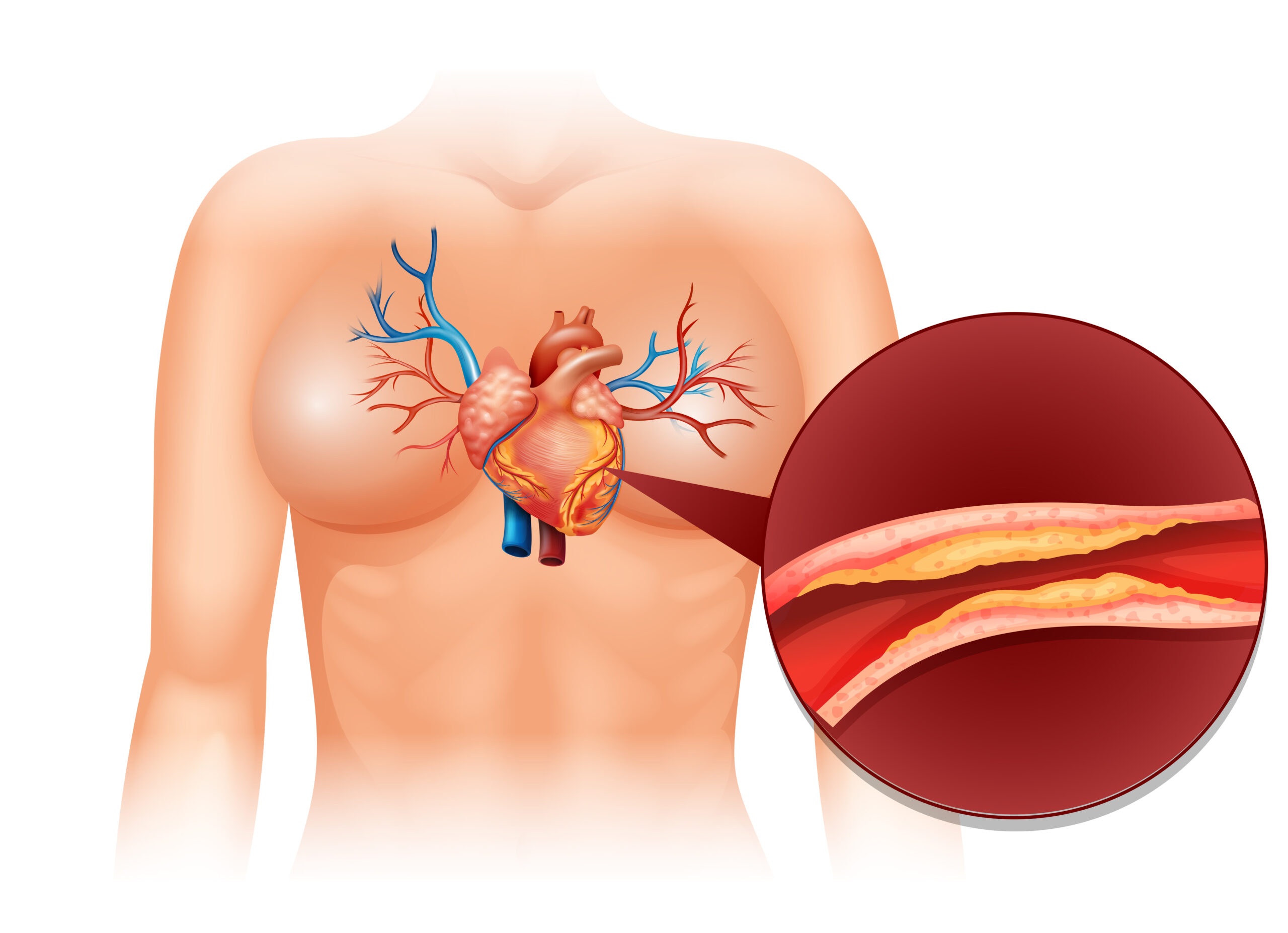 coronary heart disease treatment
